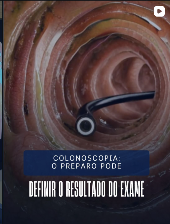 Colonoscopia: o preparo pode definir o resultado do exame