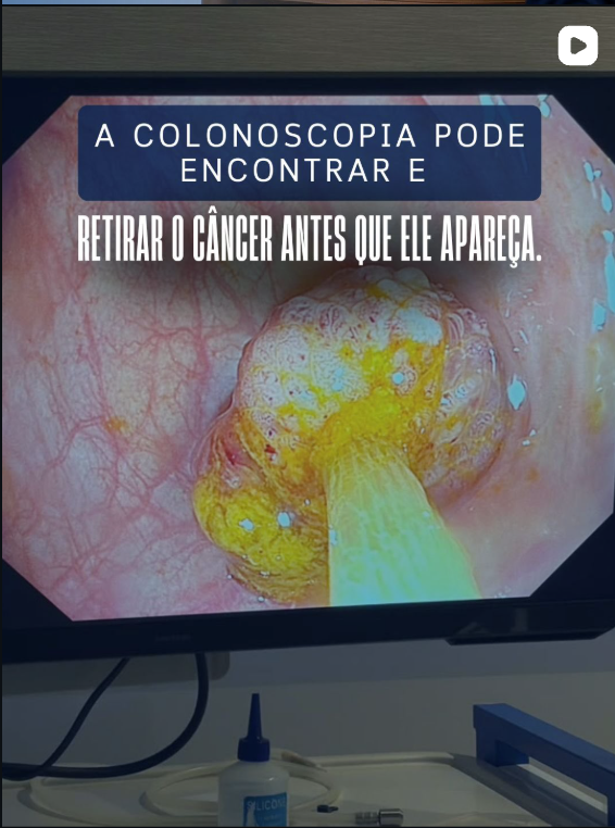 A colonoscopia pode encontrar e retirar o câncer antes que ele apareça